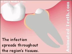Pericoronitis (wisdom tooth infection). Causes & treatment.