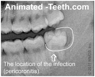 A dental x-ray showing where pericoronitis occurs.