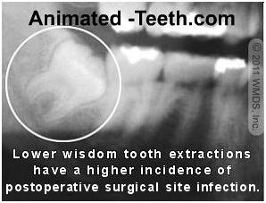Picture of x-ray showing impacted lower wisdom tooth.