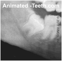 X-ray showing 2/3 and full root formation of an impacted wisdom tooth.