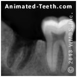 X-ray showing the socket of an extracted wisdom tooth.