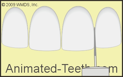 Animation showing methods a dentist uses for tooth interproximal reduction (stripping).